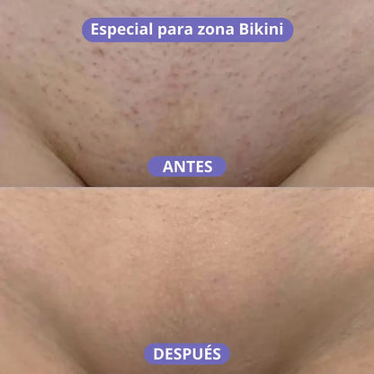 Mineva® Depiladora Láser